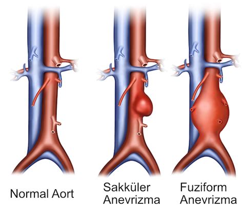 Aort Anevrizmalar Ve Diseksiyonlar Prof Dr Hakan Ger Eko Lu