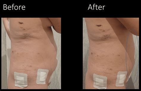 How Long Does It Take To Recover From Lipo 360 07757 946023