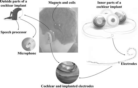 Principle and structure of a cochlear implant | Download Scientific Diagram