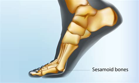 How to deal with issues with the sesamoid bone in the Foot