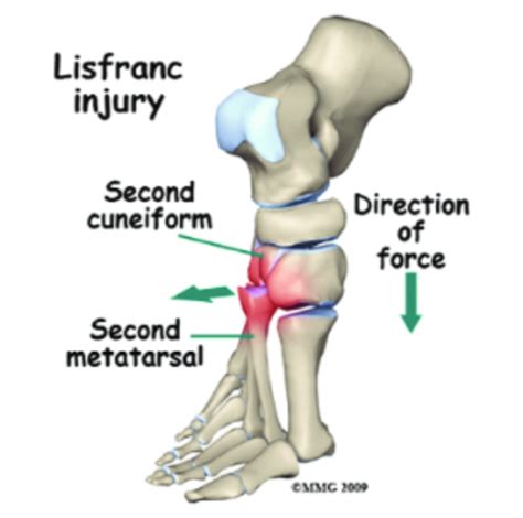 Lisfranc Injury Campbell Clinic Orthopaedics