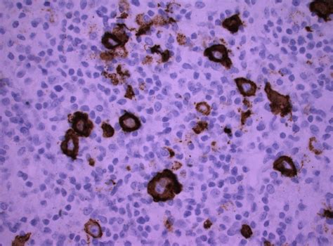 Pathology Outlines T Cell Histiocyte Rich Diffuse Large B Cell Lymphoma