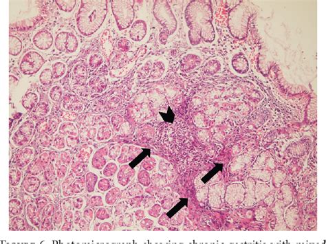 [pdf] Genotyping Of Helicobacter Pylori Virulence Genes Caga And Vaca