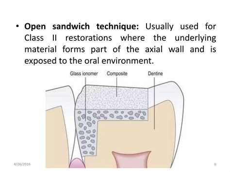 Sandwich technique | PPT