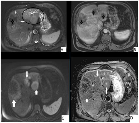 Pathogens Free Full Text Imaging Aspects Of Hepatic Alveolar Echinococcosis Retrospective