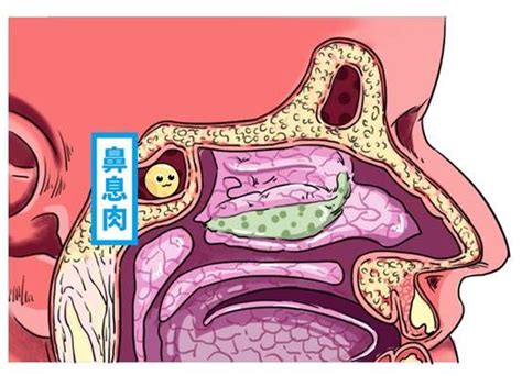 4个部位的息肉一定要及时切除，一再拖延，可能会变恶性肿瘤癌变