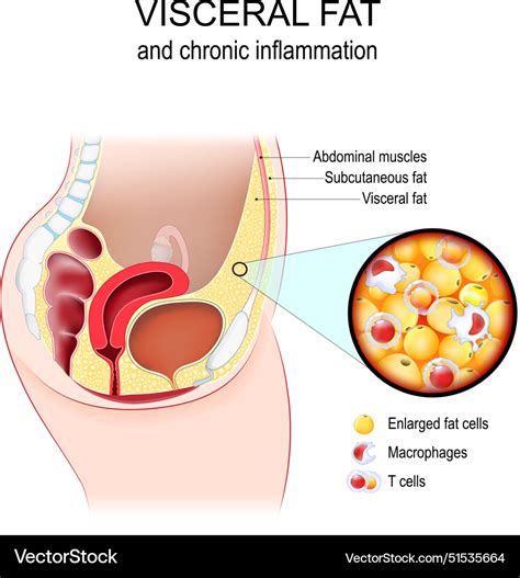 Visceral fat and chronic inflammation Royalty Free Vector