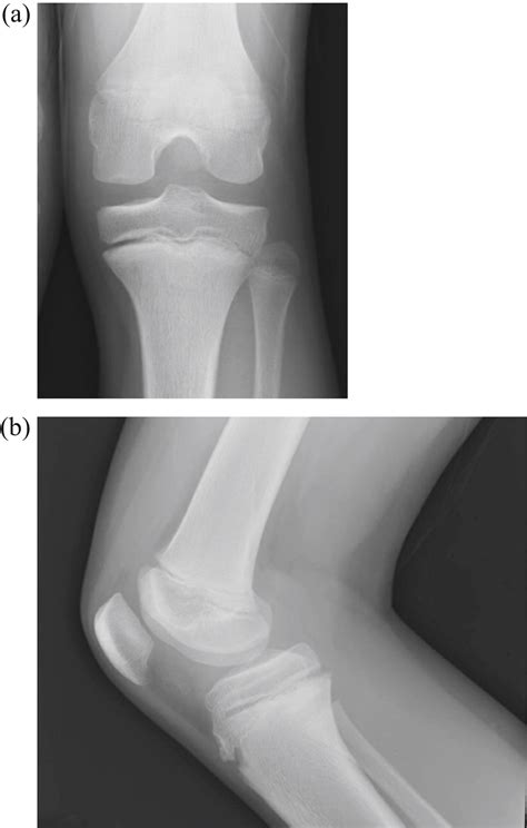 Medial Femoral Condyle Cartilage Damage