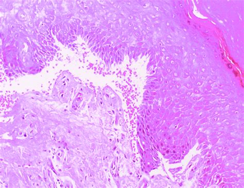 Porphyria cutanea tarda – Histopathology with hematoxilineosin stain ...