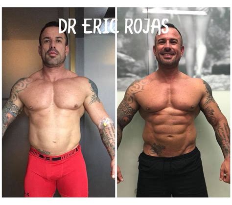 Resultados reales Slim Láser Dr Eric Rojas Dermatología Laser Center