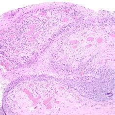 Melanoma In Situ There Is A Diffuse Proliferation Of Atypical