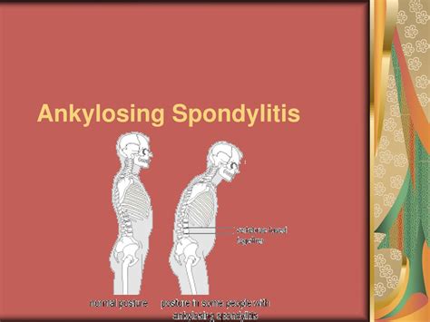 Ppt Ankylosing Spondylitis Powerpoint Presentation Free Download