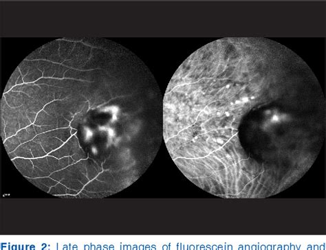 Figure 2 From A Case Of Giant Nodular Posterior Scleritis Mimicking