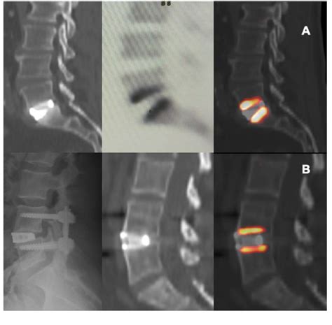 Figure From The Efficacy Of Trabecular Titanium Cages To Induce