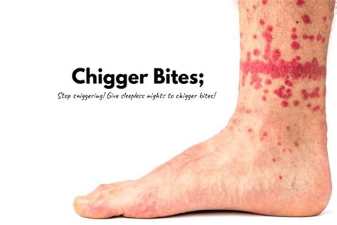 Chigger Mites Bites