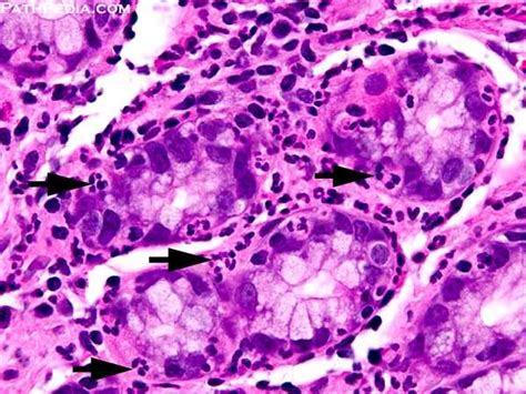 Human Diseases Seen Thru The Eyes Of A Medico: ACUTE GASTRITIS