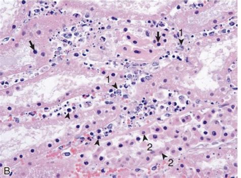 Histology of acute tubular necrosis Diagram | Quizlet