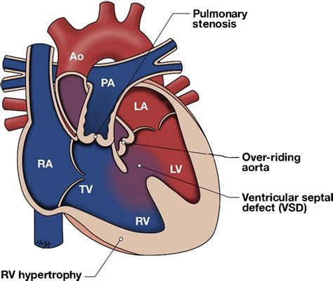 Tetralogy Of Fallot Management Of Residual Hemodynamic And Electrophysiological Abnormalities