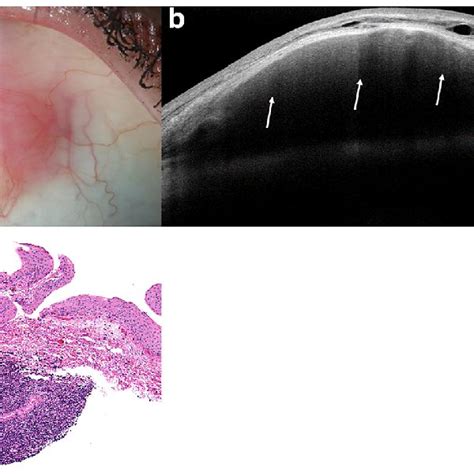 Hr Oct Findings Of Conjunctival Lymphoma Conjunctival Amyloidosis And Download Scientific