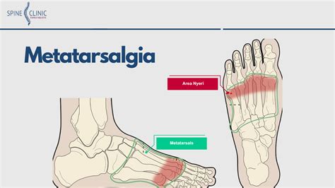 Penanganan Telapak Kaki Sakit Bagian Depan Metatarsalgia