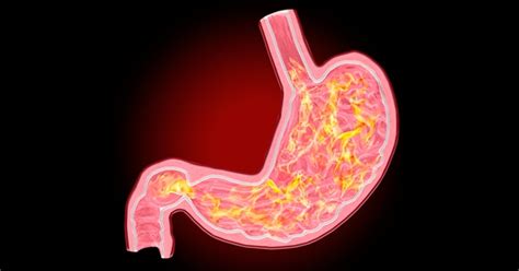 6 síntomas principales de la gastritis Maestria Salud