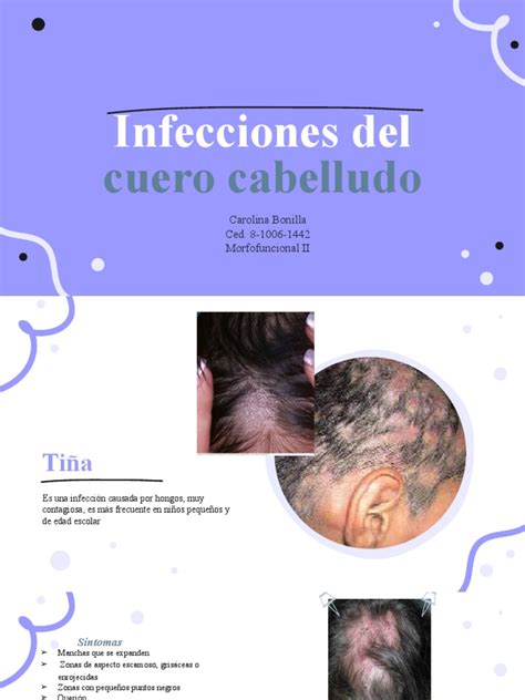 Infecciones Del Cuero Cabelludo Pdf