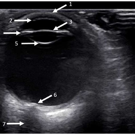 Ocular Ultrasound Of A Normal Eye The Ultrasound Probe Is Applied To