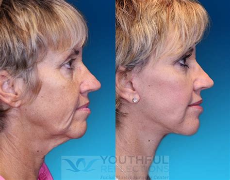 Co2 Laser Skin Resurfacing Before And After Photos Patient 1 Nashville