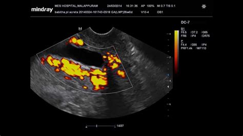 Placenta Percreta Doppler Drvahabkp Youtube