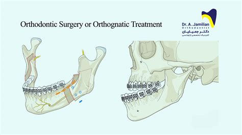 Orthodontic Surgery Or Orthognathic Treatment Dr Jamilian