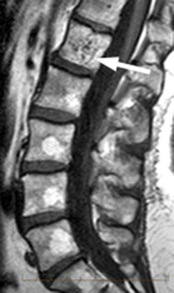 RadiologySpirit: Atypical hemangioma