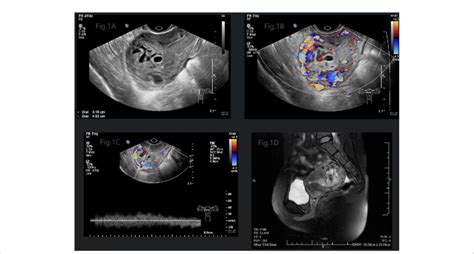 A Gray Scale Pelvic Sonography Displayed A Mixed Echogenic Mass In Download Scientific