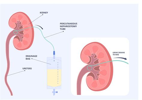 CATHETER INSERTION – Elite Diagnostic