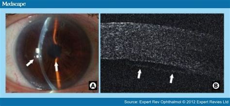 Oct In Cornea And Refractive Surgery Page 3