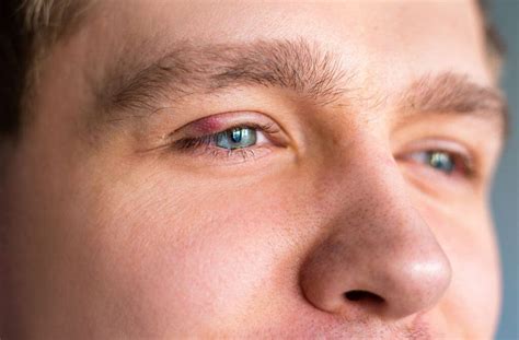 Chalazion Vs Stye Whats The Difference And Treatment Options — Colorado Eye Surgeons