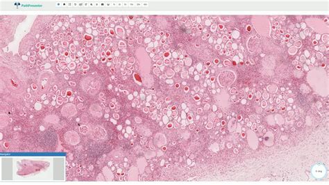 Chronic Pyelonephritis Histology