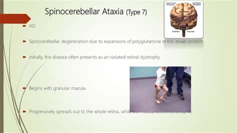 Cone and Rod Dystrophy