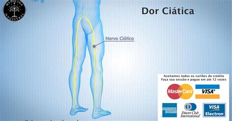 Acupuntura Homecare Dor Ciática