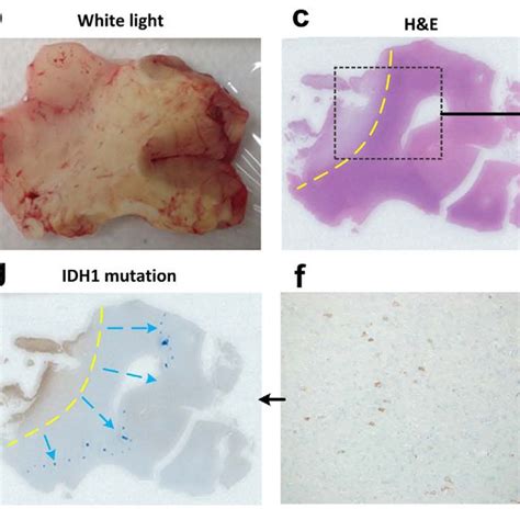 Delineation Of Tumor Margin With TRI A TRI Image Of A WHO Grade II