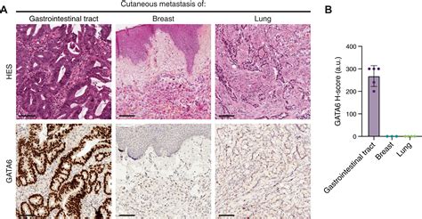 Diagnostic Accuracy Of GATA6 Immunostaining In Sebaceous Tumors Of The