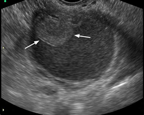 Atypical Endometrioma In A 29 Year Old Woman Transvaginal