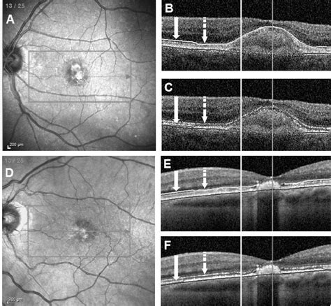 Figure 1 From Ellipsoid Zone Thickness In Sporadic Adult Onset Foveomacular Vitelliform