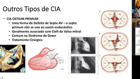 Fop Cia Oclus O Percut Nea De Shunts Intra Card Acos Dr Ant Nio Neri