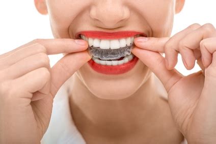 Dr Nechupadam Dentals Clear Aligners Dr Nechupadam Dental Clinic