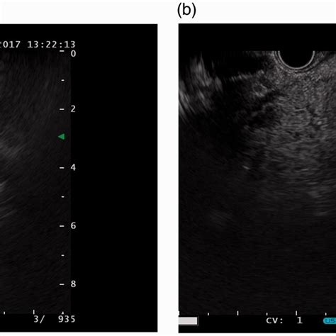 Endoscopic Ultrasound A The Head Of The Pancreas Was Enlarged And Download Scientific