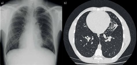 A Chest Radiograph Showing Dextrocardia B High Resolution Computed