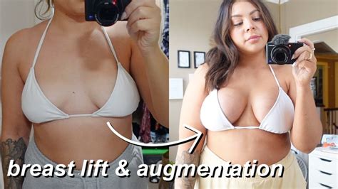 My Breast Augmentation And Lift Mastopexy Experience Everything You