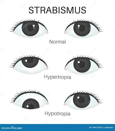 Strabismus Types. Hypotropia, Hypertropia, Exotropia, Esotropia. Human Eyes With Different ...