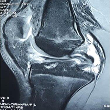 Complex tear of MM MRI reveals a diffuse intrameniscal hyperintensity ...