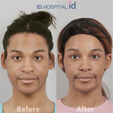 I Had ‘facial Feminization Surgery At Id Hospital Idhospital